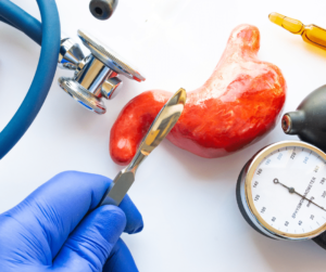 Inteligencia Artificial en Cirugía Bariátrica