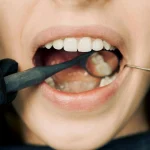 ISEE, CURSOS ONLINE- Diplomado en Técnicas Avanzadas de Blanqueamiento Dental